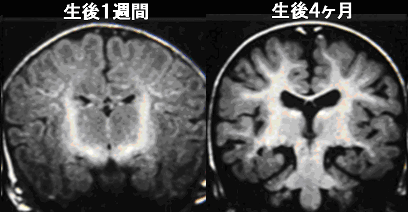 同一人物のMRI脳画像。左は生後1週間、右は生後4カ月。白く映し出されているのが運動系・感覚系の脳の枝ぶり（髄鞘形成）で、わずか4カ月で大きく進展しているのが見てとれる。　※『脳は自分で育てられる』（加藤俊徳著・光文社）より引用