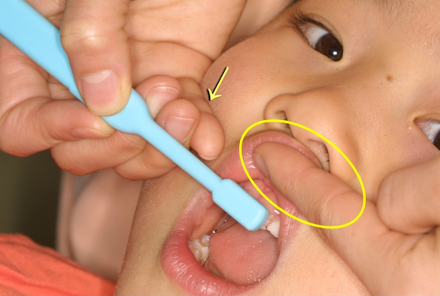 歯ブラシを持った手の小指（矢印で示したところ）は、ほおにぴったり固定する。反対の手の人差し指で、上唇小帯をカバーする（楕円で示したところ）。（写真／クラジ歯科医院）


